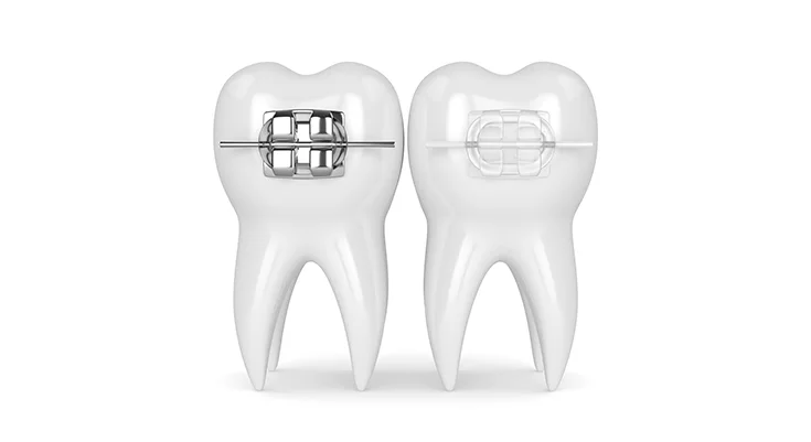 Fixed metal and aesthetic braces and fixed self-ligating braces