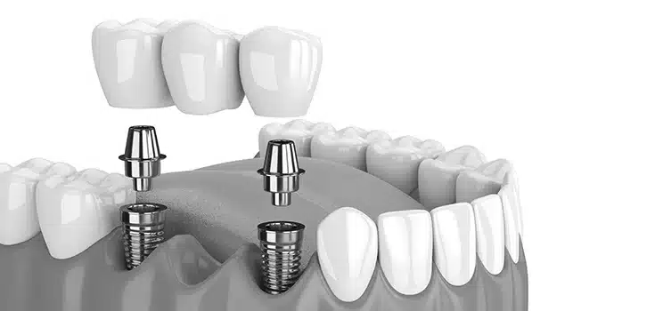 szczęka implant zdjęcie