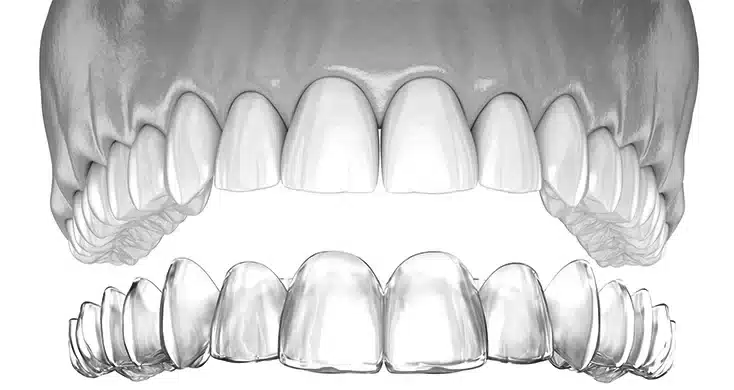 Invisalign and clear aligners