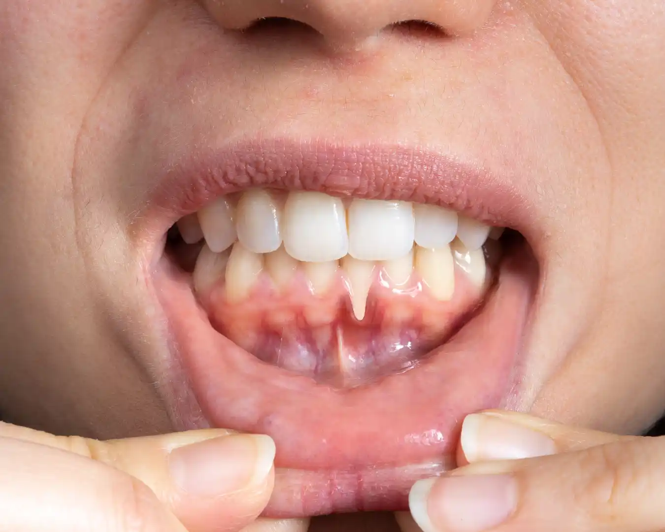 początek paradontozy